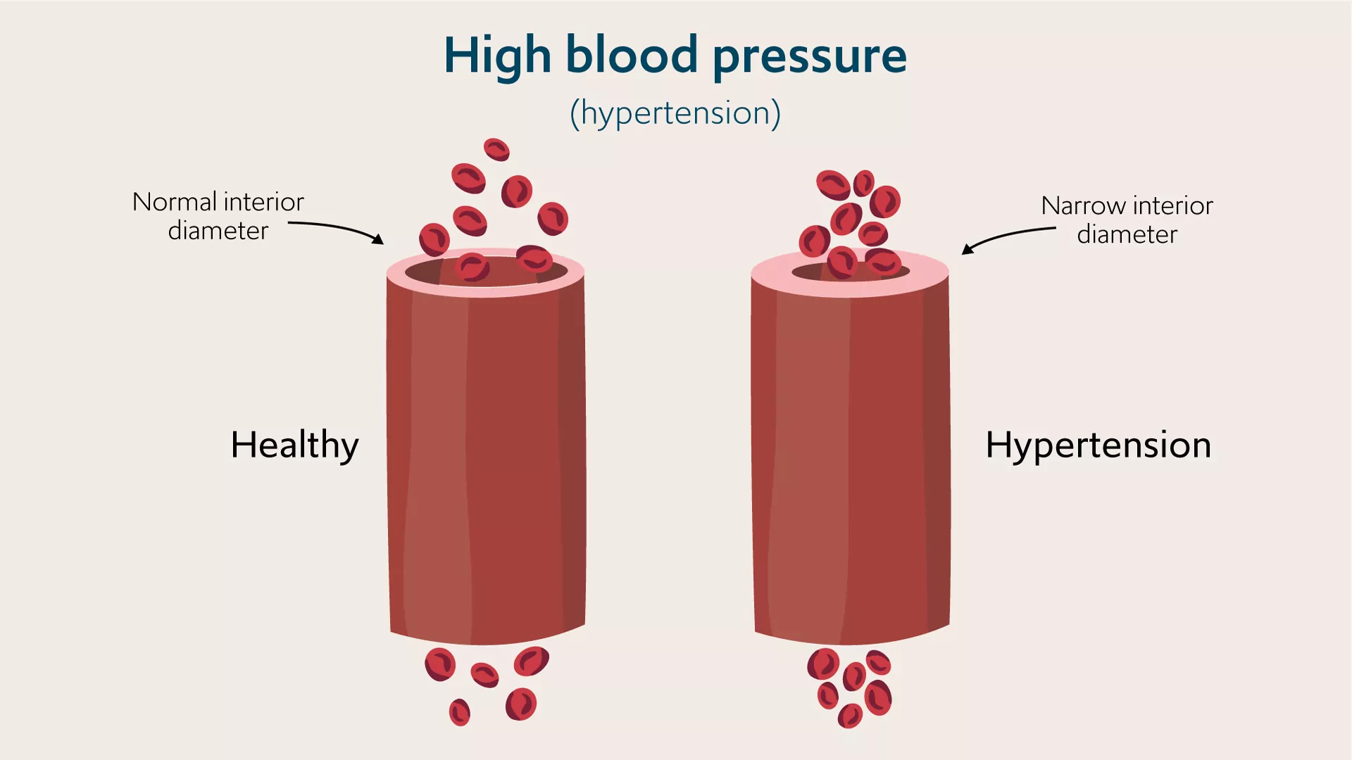 Hypertension: Why High Blood Pressure Should Not Be Ignored